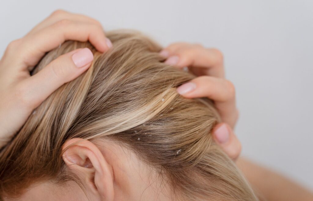 Cuero cabelludo con dermatitis y descamación