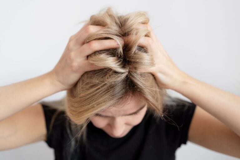 Dermatitis en el cuero cabelludo: la guía definitiva para frenar los primeros brotes y recuperar el equilibrio capilar